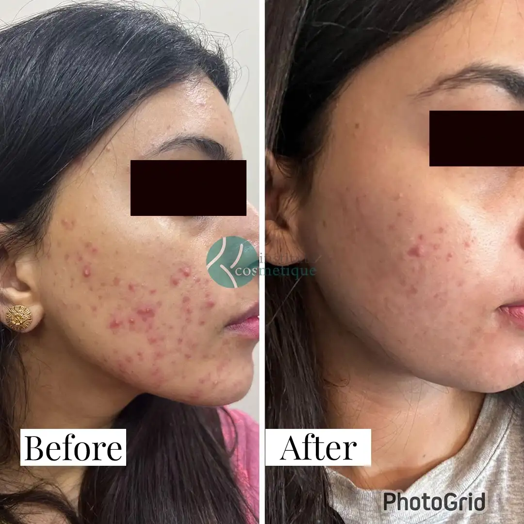 Skin tightening and wrinkle reduction before and after HIFU therapy at Institute Cosmetique